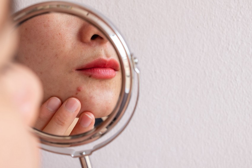 Acne na mulher adulta: causas primárias e tratamento