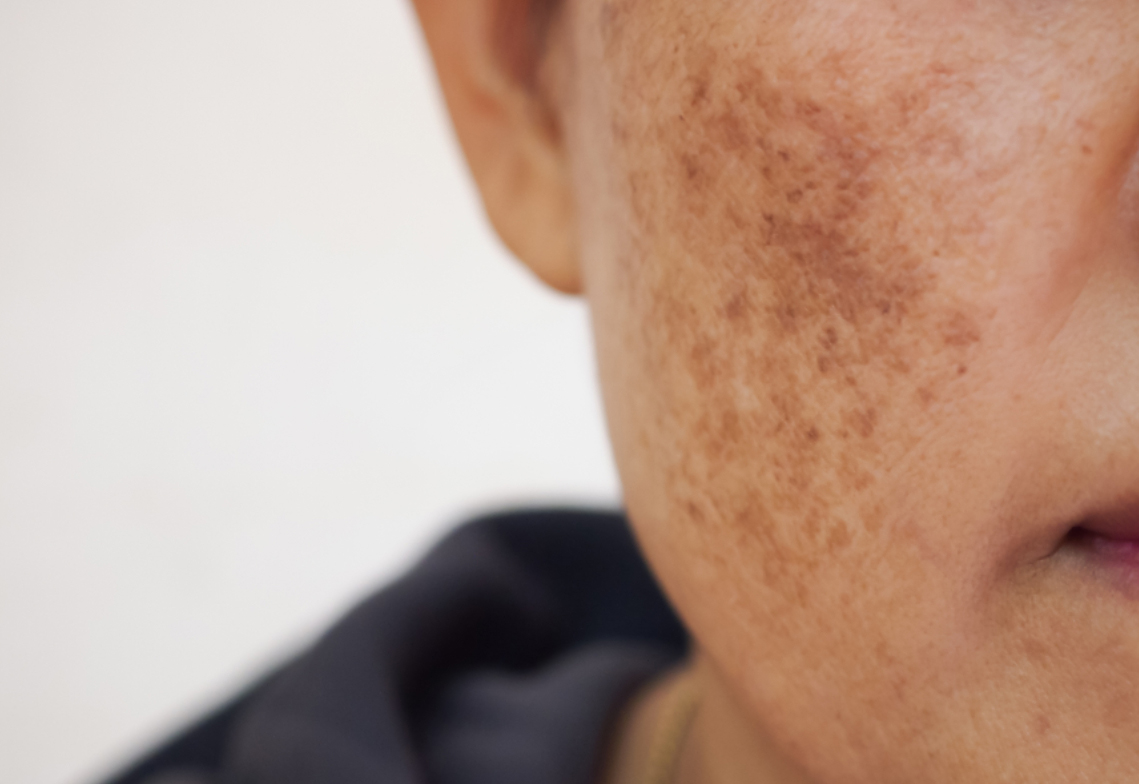 Melasma: Estratégias para Clarear Manchas na Pele